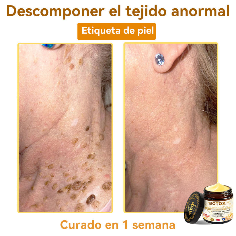 Universidad de Barcelona Oficial: 𝐒𝐩𝐳𝐯®𝐁𝐎𝐓𝐎𝐗 𝐕𝐞𝐧𝐞𝐧𝐨 𝐝𝐞 𝐚𝐛𝐞𝐣𝐚 𝐂𝐫𝐞𝐦𝐚 𝐝𝐞 𝐭𝐫𝐚𝐭𝐚𝐦𝐢𝐞𝐧𝐭𝐨 𝐜𝐮𝐭á𝐧𝐞𝐨, Hidratación, reparación de la piel, uniformización del tono, tratamiento del acné y manchas oscuras, eliminación de verrugas y lunares, alivio de la psoriasis