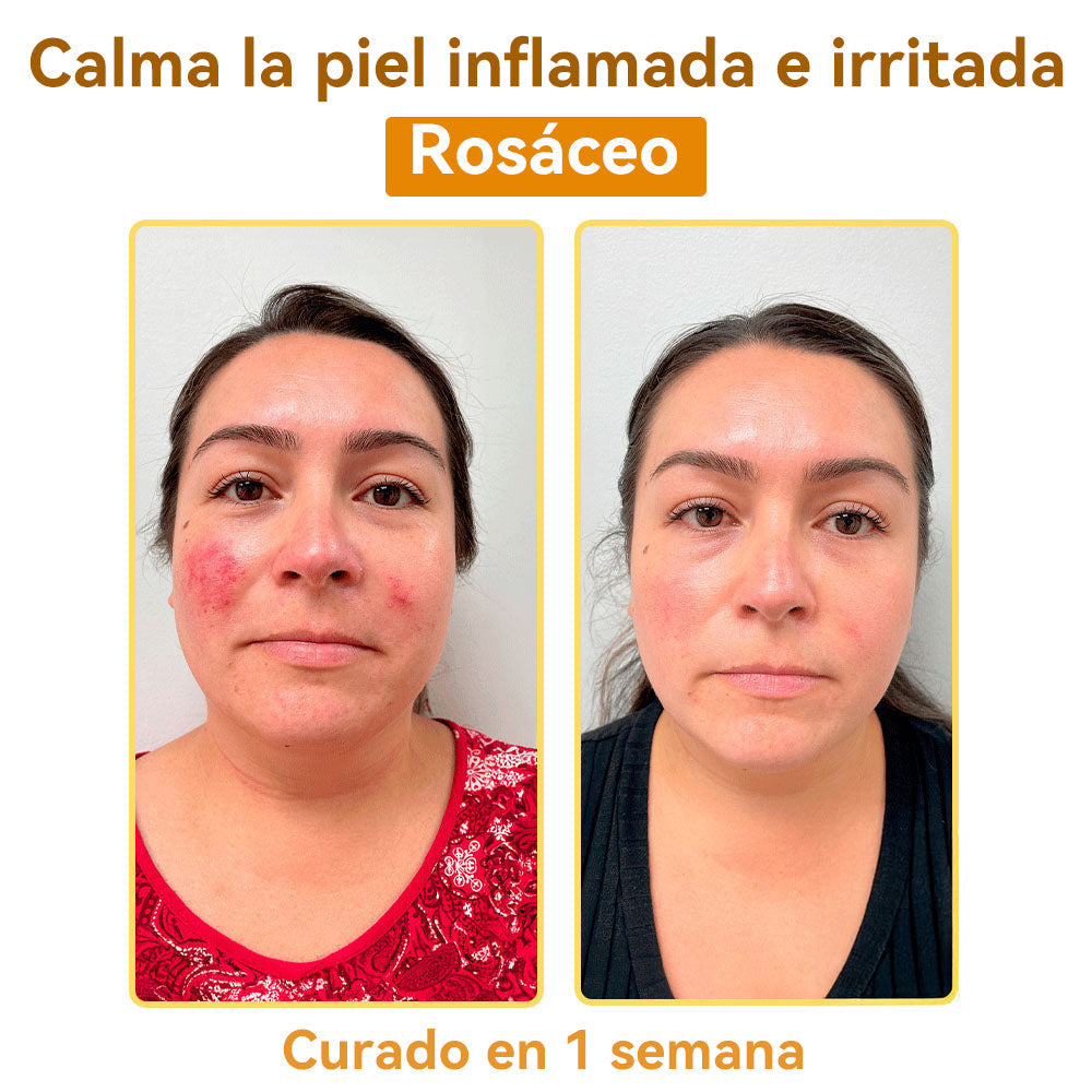 Universidad de Barcelona Oficial: 𝐒𝐩𝐳𝐯®𝐁𝐎𝐓𝐎𝐗 𝐕𝐞𝐧𝐞𝐧𝐨 𝐝𝐞 𝐚𝐛𝐞𝐣𝐚 𝐂𝐫𝐞𝐦𝐚 𝐝𝐞 𝐭𝐫𝐚𝐭𝐚𝐦𝐢𝐞𝐧𝐭𝐨 𝐜𝐮𝐭á𝐧𝐞𝐨, Hidratación, reparación de la piel, uniformización del tono, tratamiento del acné y manchas oscuras, eliminación de verrugas y lunares, alivio de la psoriasis