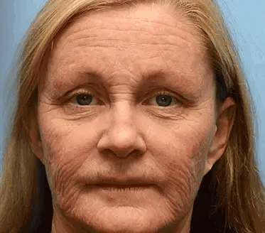 Universidad de Barcelona Oficial: 𝐒𝐩𝐳𝐯®𝐁𝐎𝐓𝐎𝐗 𝐕𝐞𝐧𝐞𝐧𝐨 𝐝𝐞 𝐚𝐛𝐞𝐣𝐚 𝐂𝐫𝐞𝐦𝐚 𝐝𝐞 𝐭𝐫𝐚𝐭𝐚𝐦𝐢𝐞𝐧𝐭𝐨 𝐜𝐮𝐭á𝐧𝐞𝐨, Hidratación, reparación de la piel, uniformización del tono, tratamiento del acné y manchas oscuras, eliminación de verrugas y lunares, alivio de la psoriasis